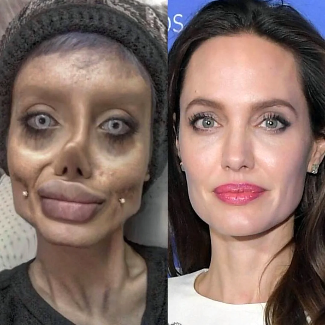 Анджелина Джоли операции